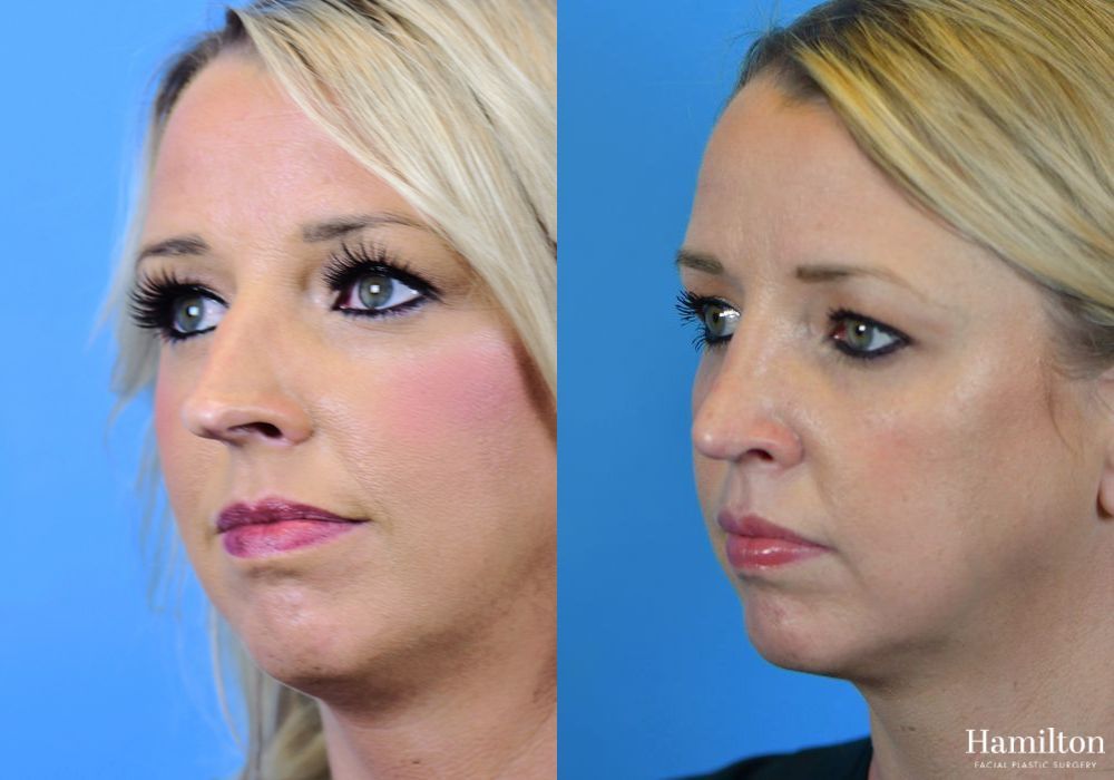 Before and after Rhinoplasty case 37259 - Angle 4