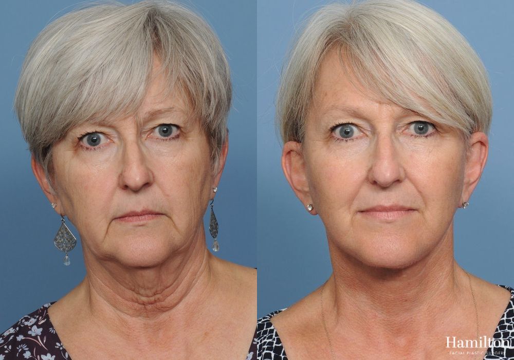 Before and after Neck Rejuvenation case 37127 - Angle 2