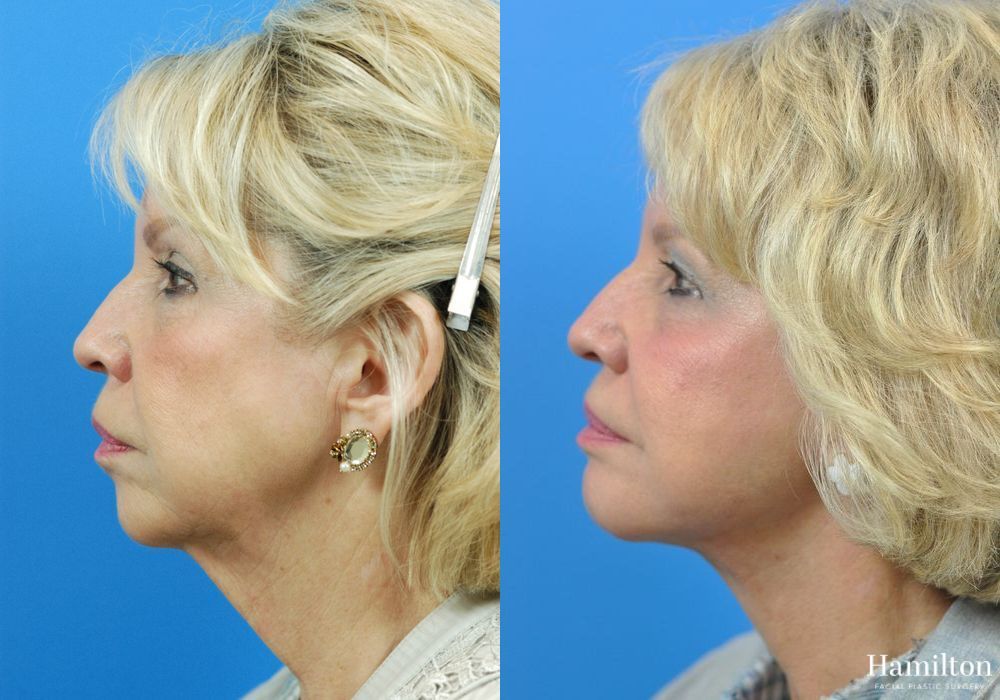 Before and after Chin Augmentation case 37193 - Angle 3