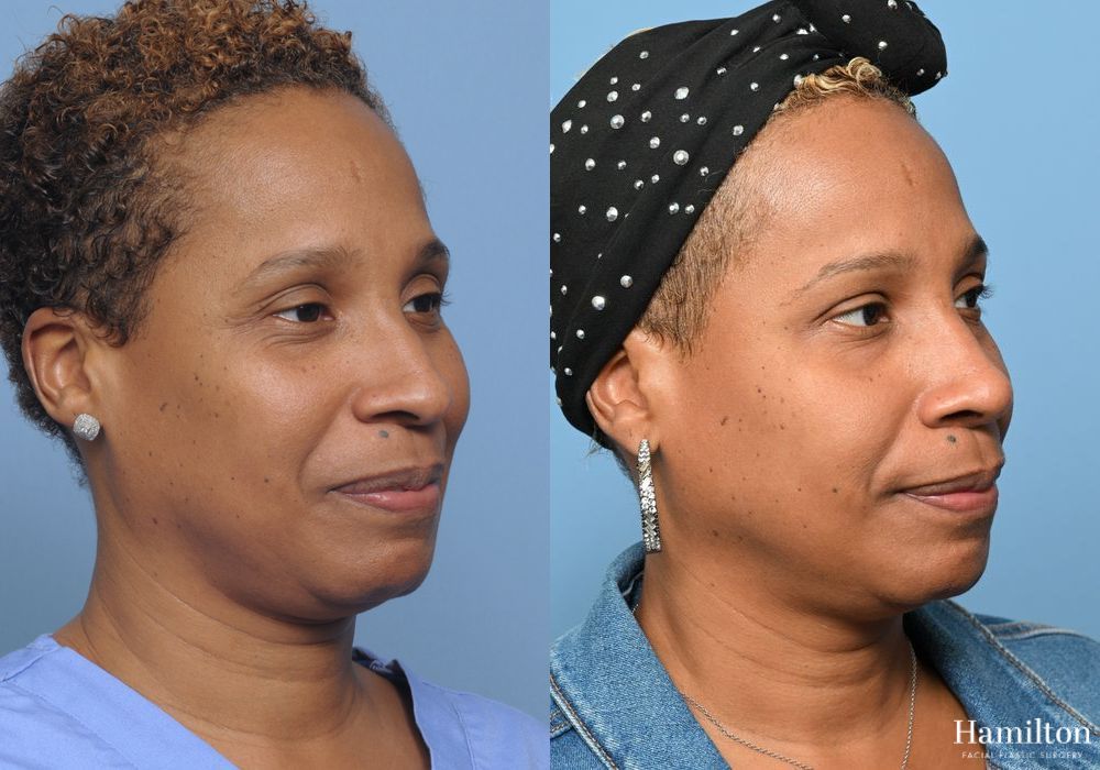 Before and after Rhinoplasty case 37298 - Angle 2