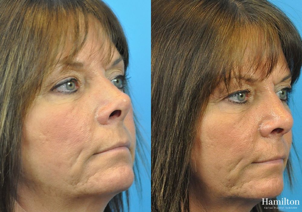 Before and after Rhinoplasty case 37346