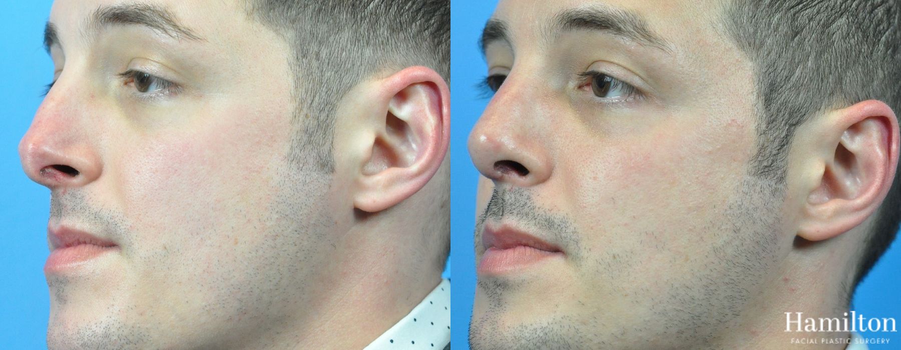 Before and after Rhinoplasty case 37333 - Angle 3