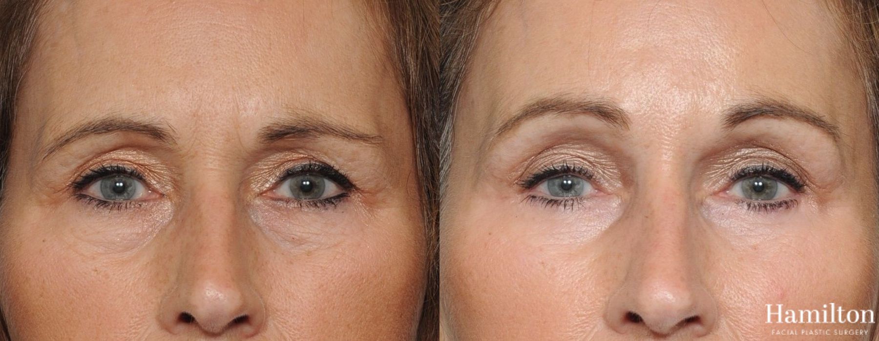 Before and after Blepharoplasty case 37305