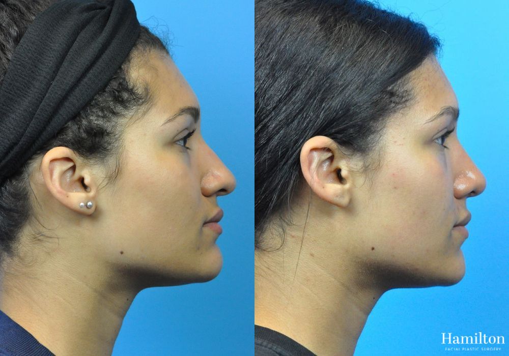 Before and after Rhinoplasty case 37331 - Angle 3