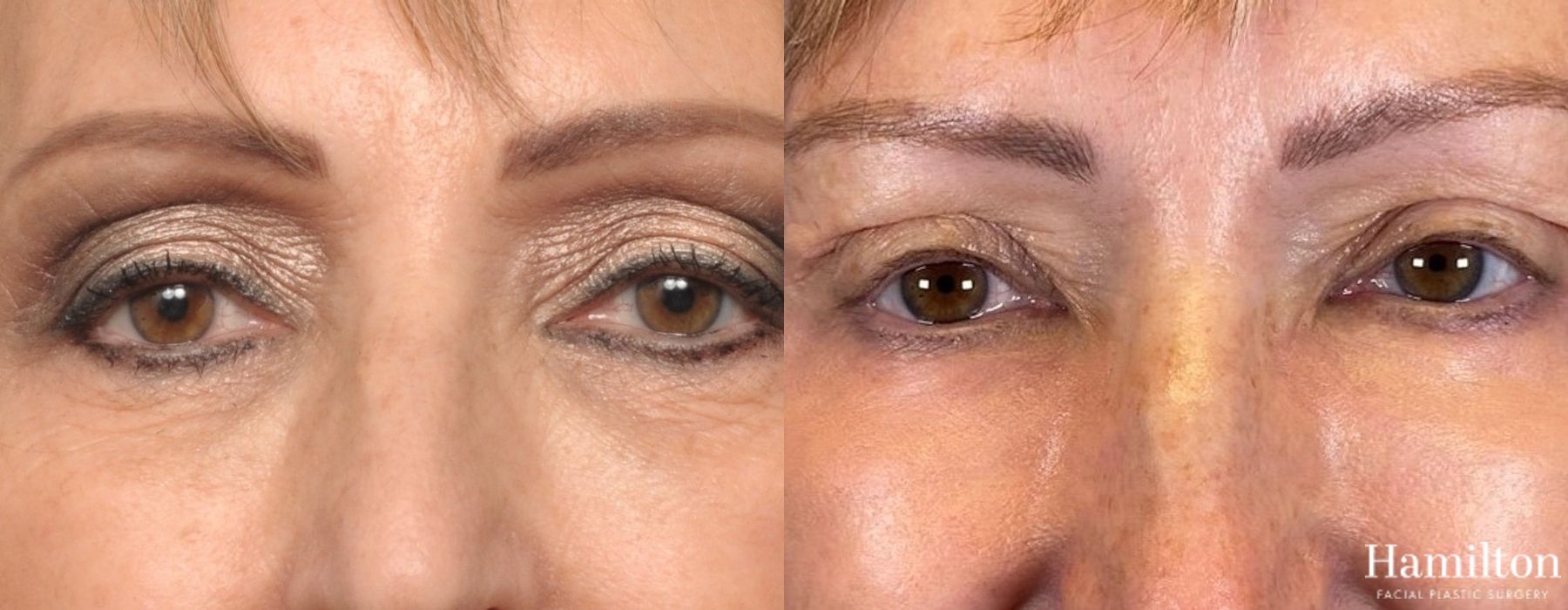 Before and after Laser - Sciton case 37141