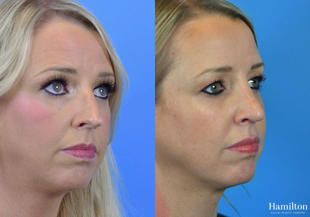 Before and after Rhinoplasty case 37259 - Angle 3