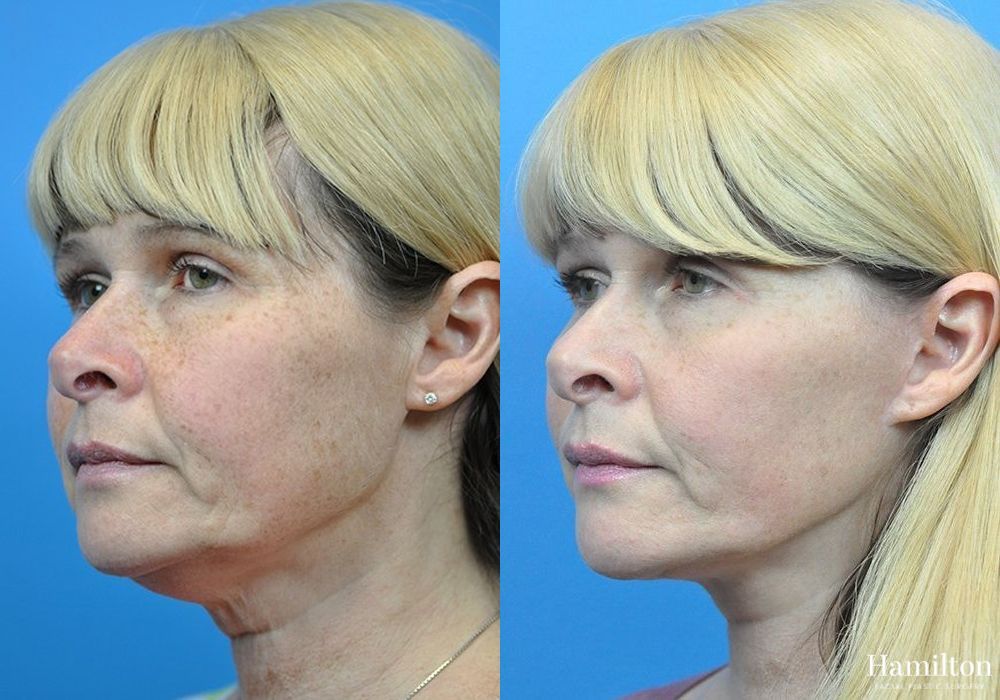 Before and after Facelift case 37261 - Angle 2