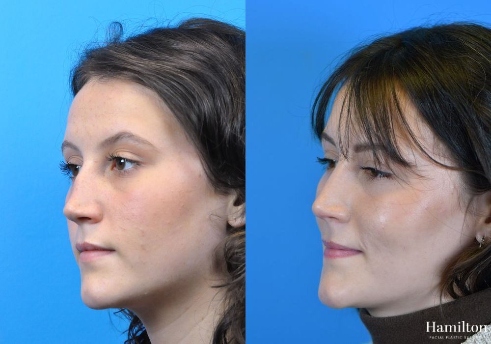 Before and after Rhinoplasty case 37275 - Angle 4