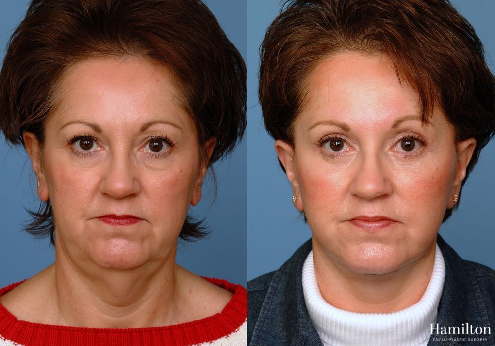 Before and after Facelift case 37283 - Angle 3