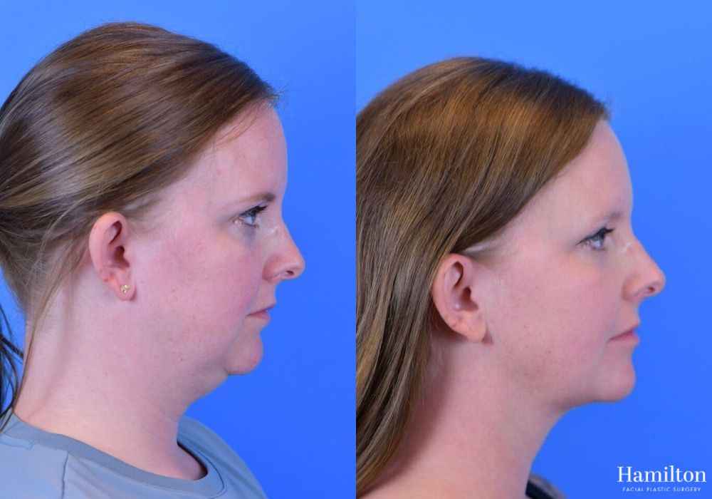 Before and after FaceTite case 37108 - Angle 5