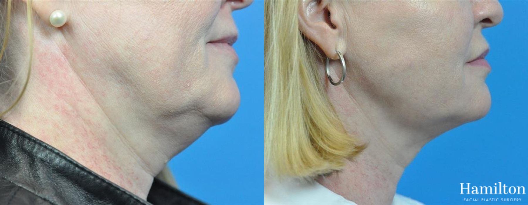 Before and after FaceTite case 37148 - Angle 3