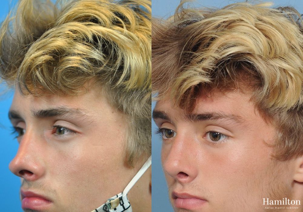 Before and after Rhinoplasty case 37244 - Angle 3