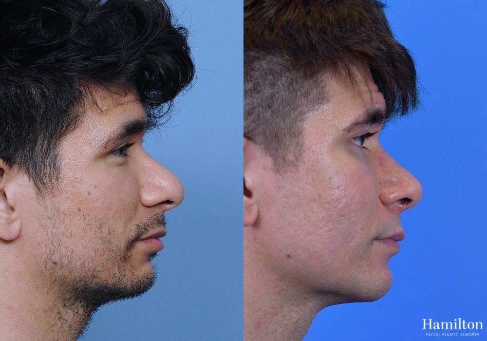 Before and after Rhinoplasty case 37271
