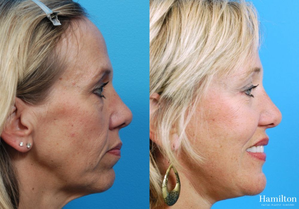 Before and after Facelift case 37286 - Angle 3