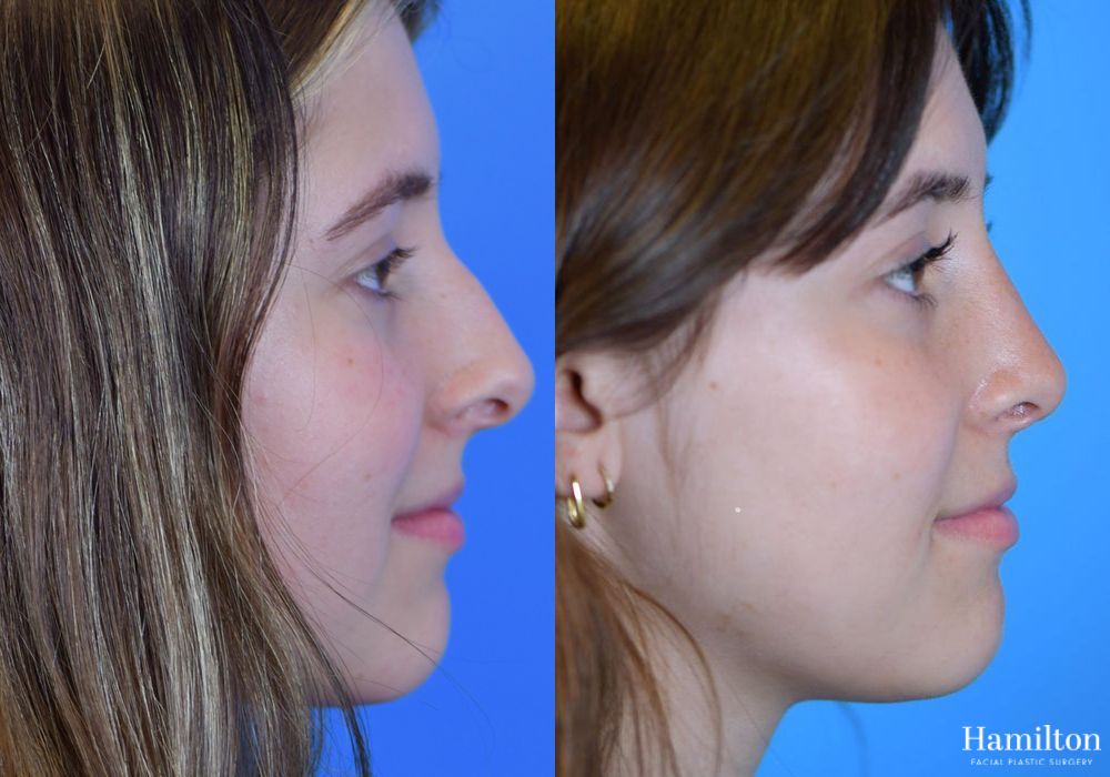 Before and after Rhinoplasty case 37336 - Angle 3