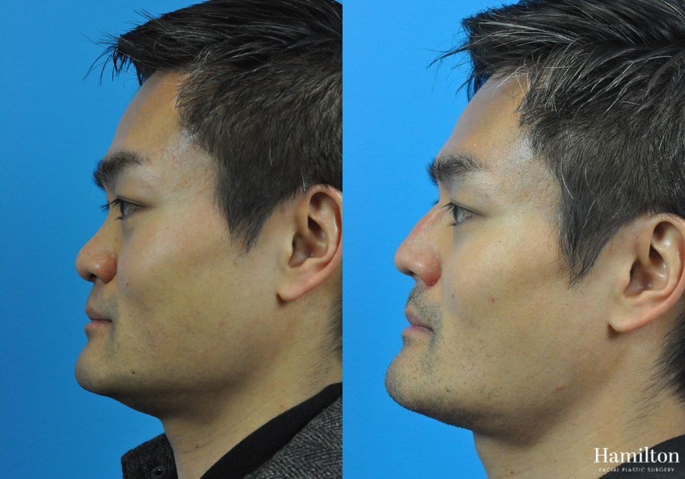 Before and after Rhinoplasty case 37288 - Angle 2