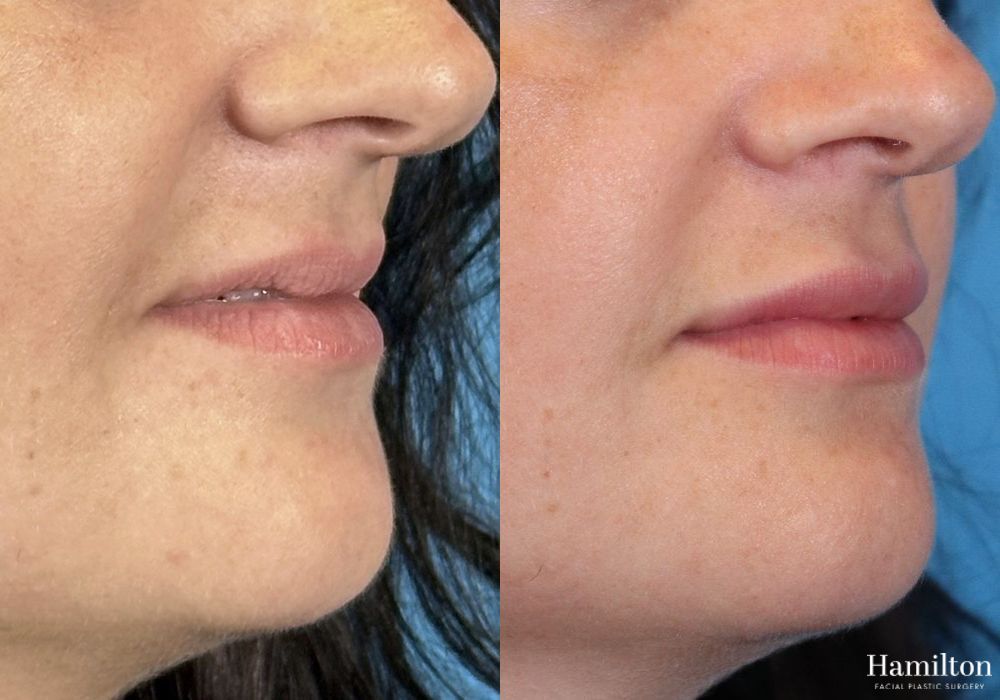 Before and after Lip Enhancement case 37152
