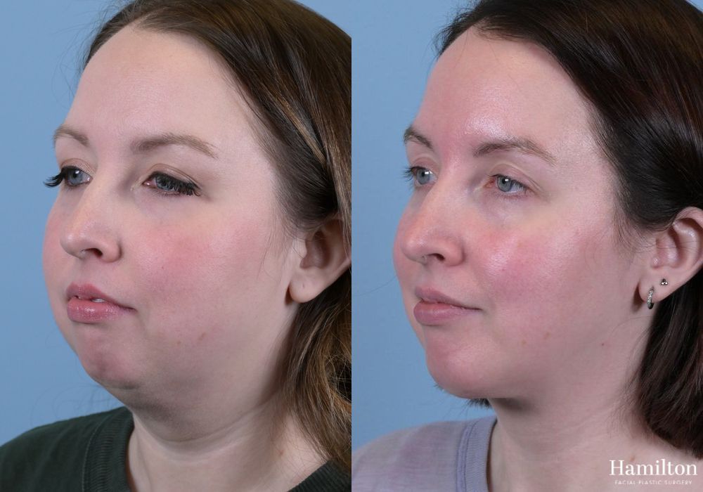Before and after Submentoplasty/Deep Neck Lift case 37358 - Angle 4