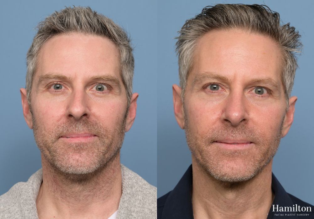 Before and after Rhinoplasty case 37134 - Angle 5