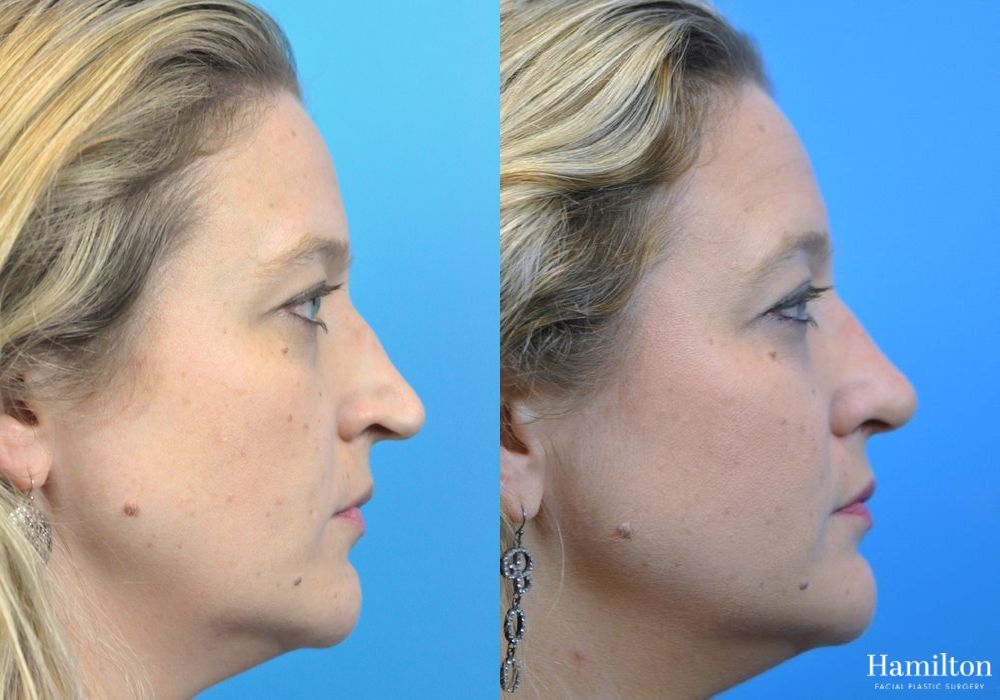 Before and after Rhinoplasty case 37330 - Angle 2