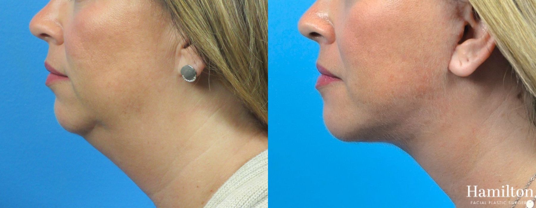 Before and after Neck Rejuvenation case 37187