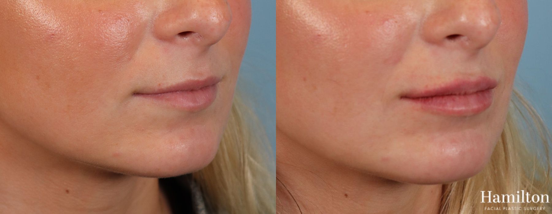 Before and after Lip Enhancement case 37173