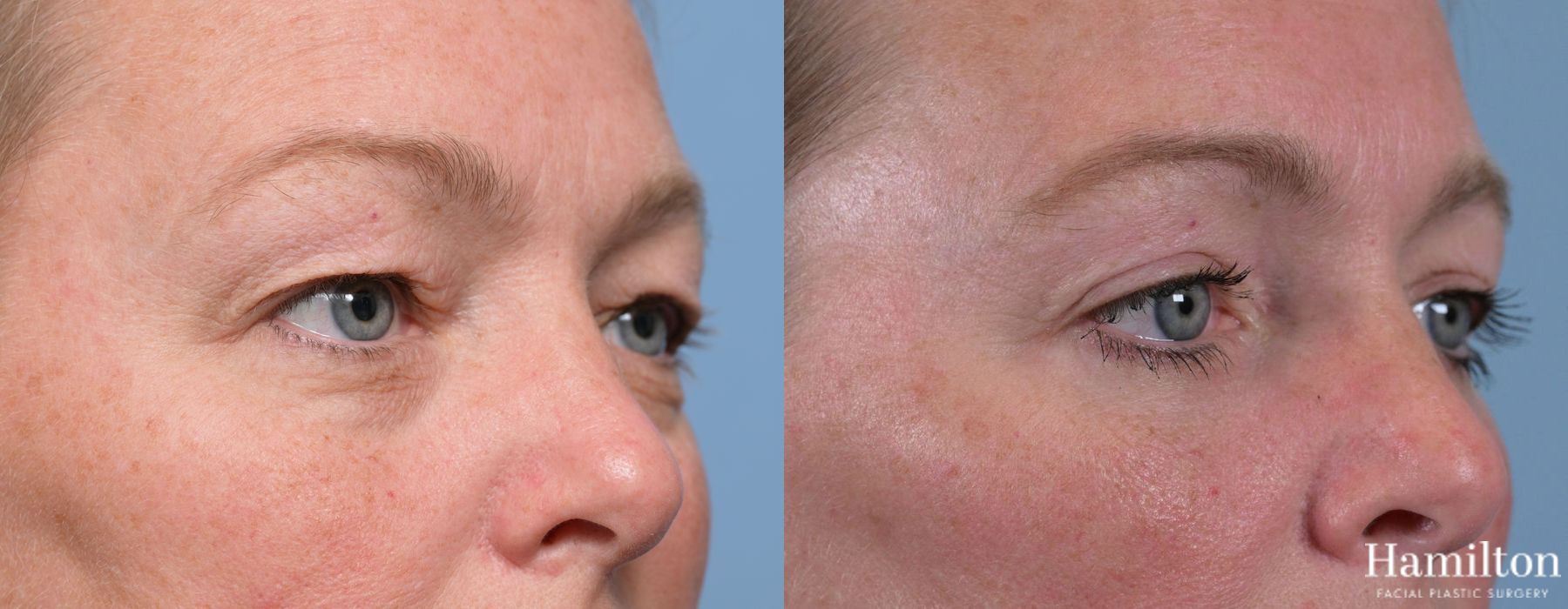 Before and after Blepharoplasty case 37119 - Angle 3