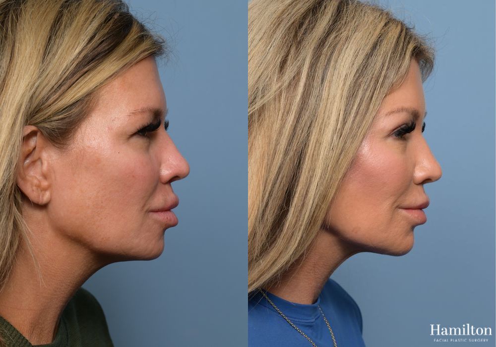 Before and after Brow Lift case 37111 - Angle 4