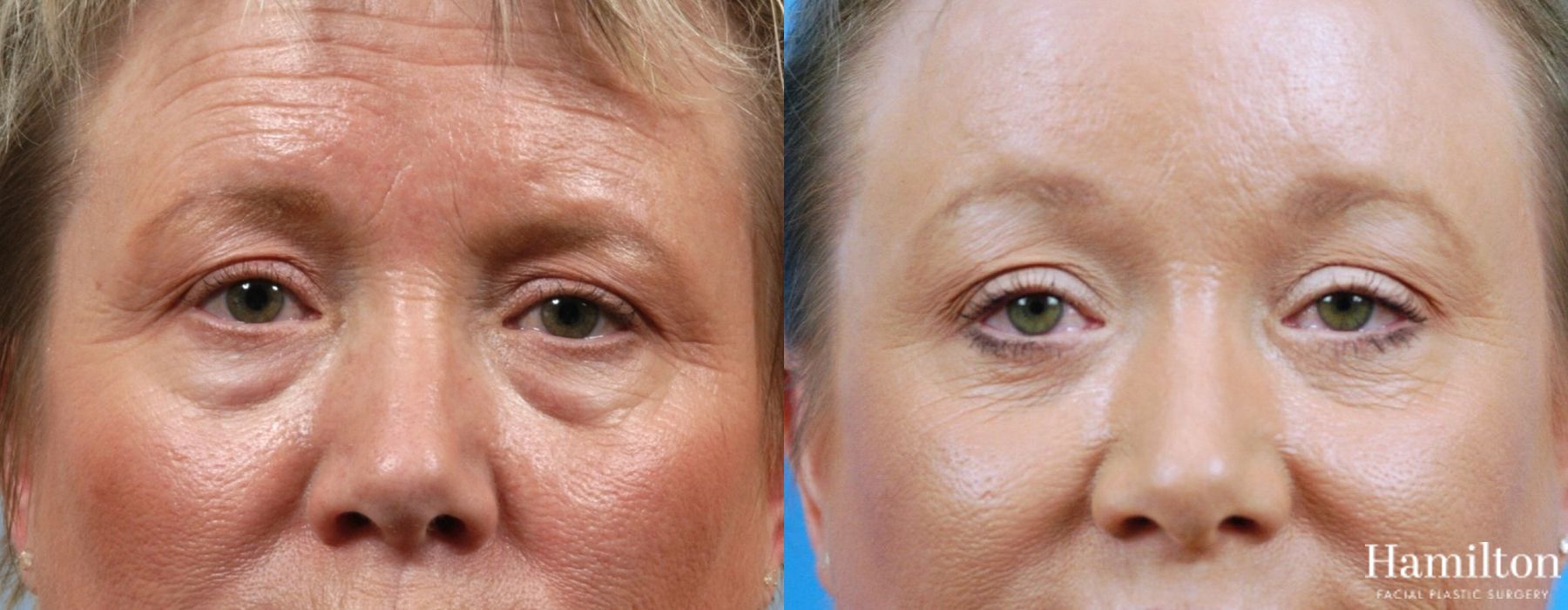 Before and after Blepharoplasty case 37284