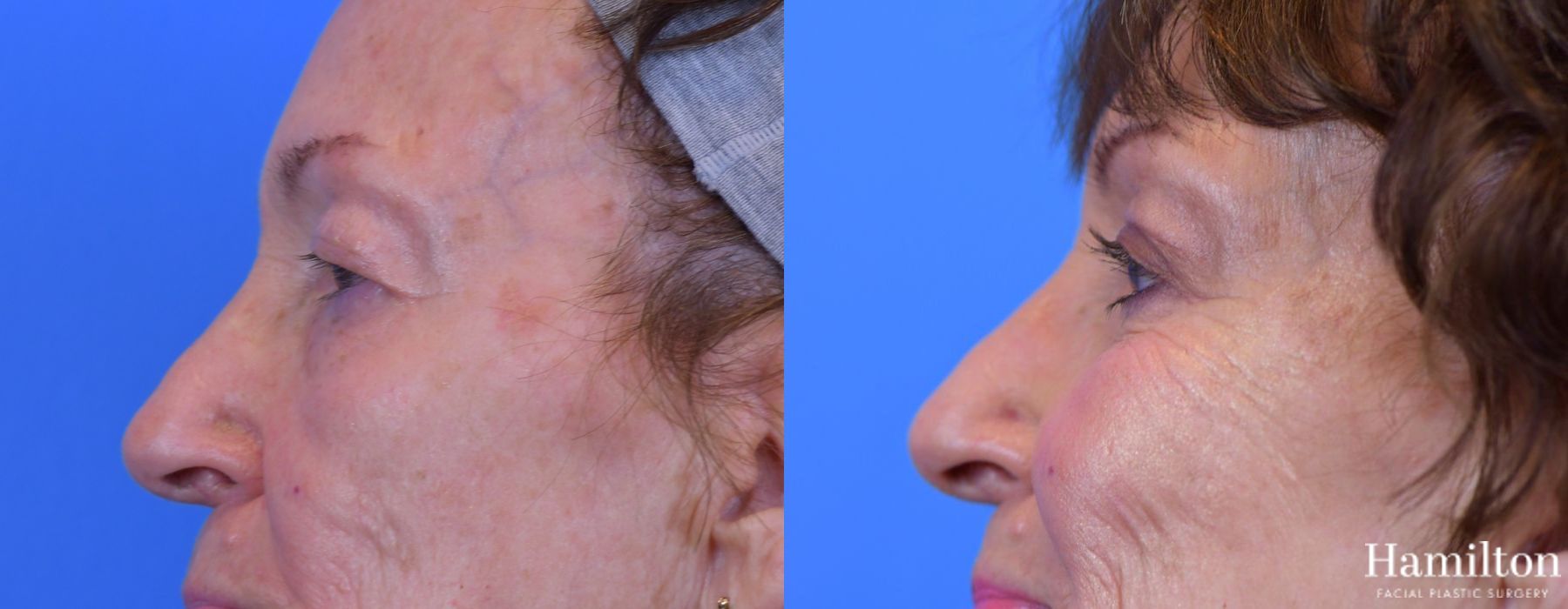 Before and after Blepharoplasty case 37297 - Angle 2