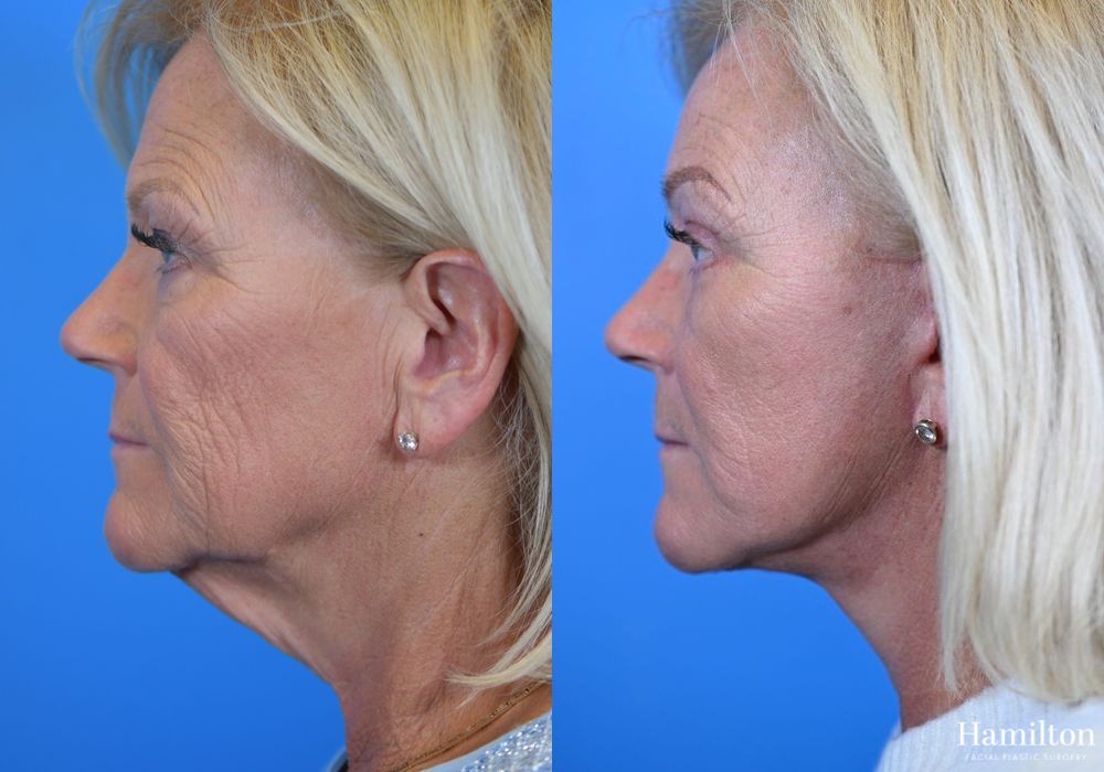 Before and after Facelift case 37233 - Angle 3