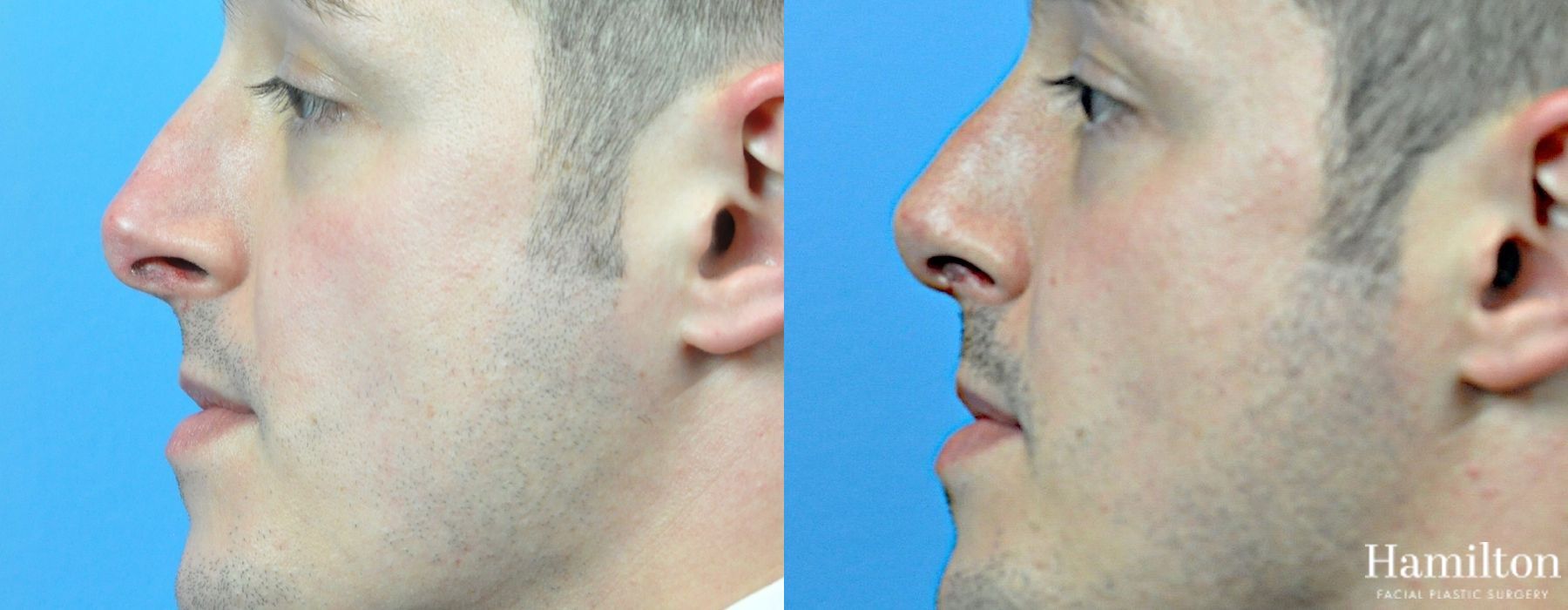 Before and after Rhinoplasty case 37333 - Angle 6