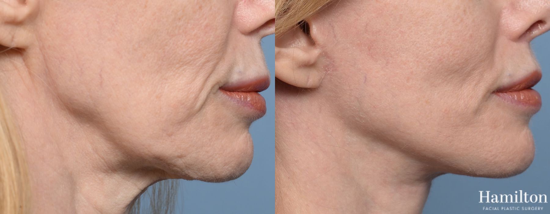 Before and after Lip Lift case 37100