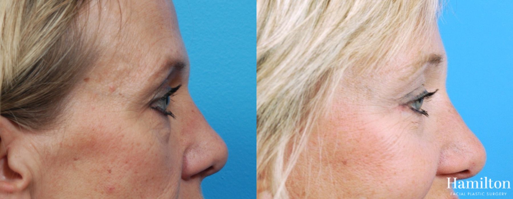 Before and after Blepharoplasty case 37216 - Angle 3