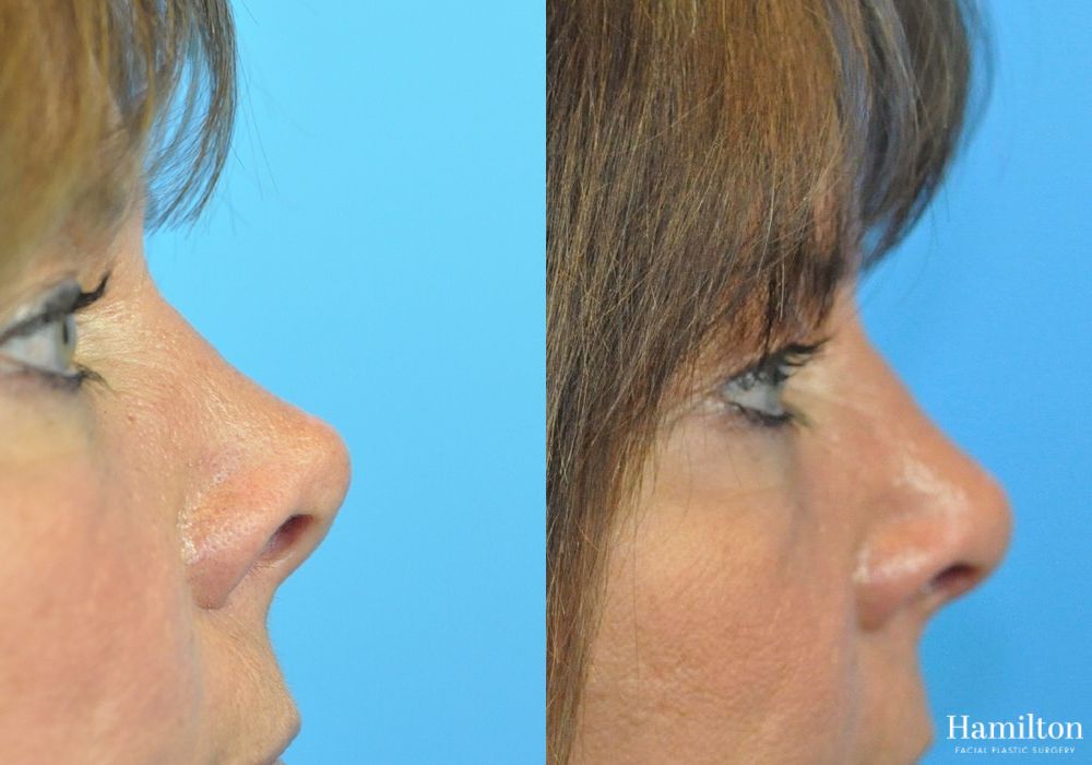Before and after Rhinoplasty case 37346 - Angle 3