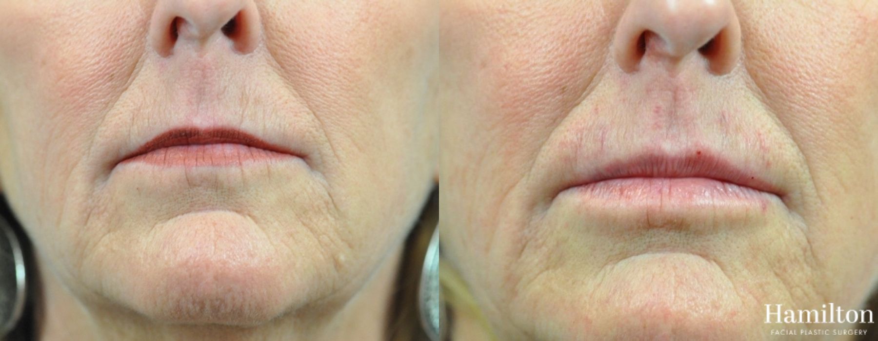 Before and after Lip Enhancement case 37241