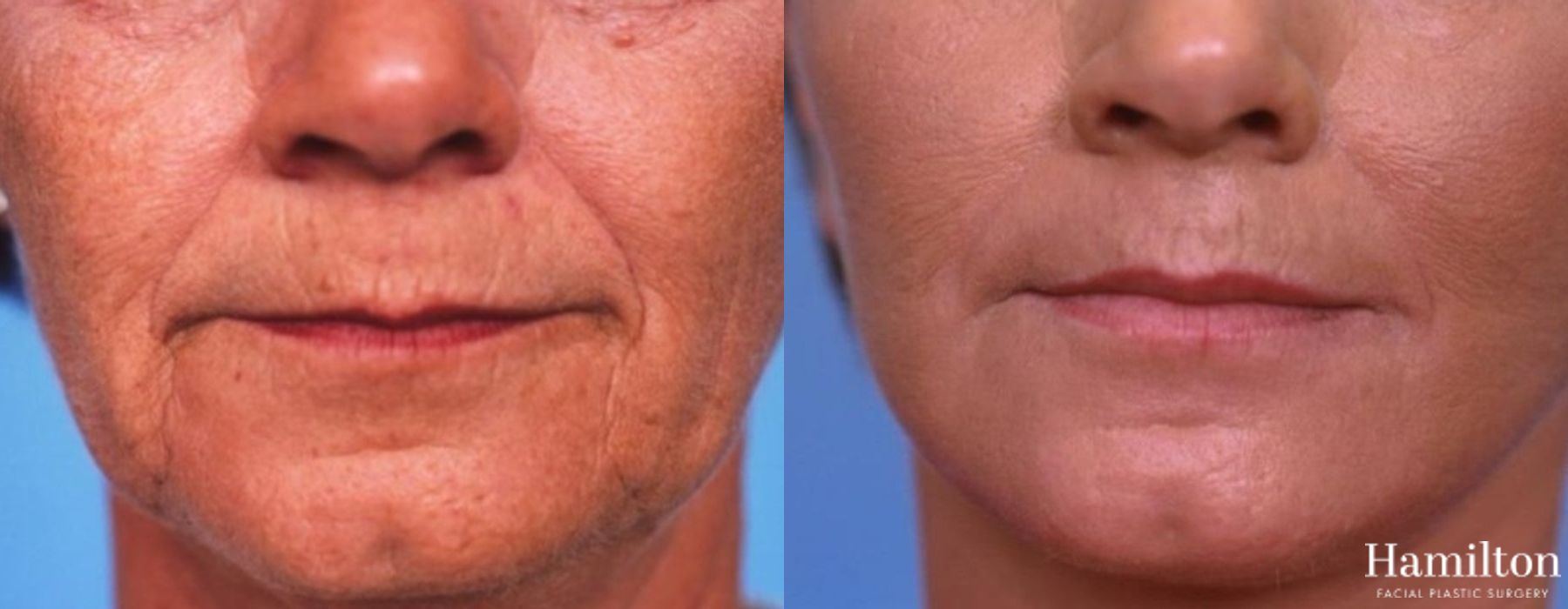 Before and after Facelift case 37324 - Angle 5