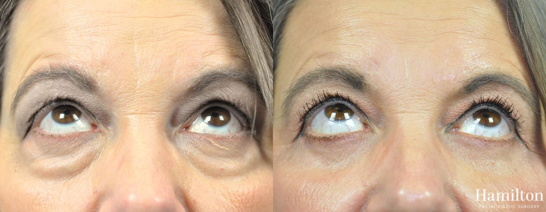 Before and after Blepharoplasty case 37226