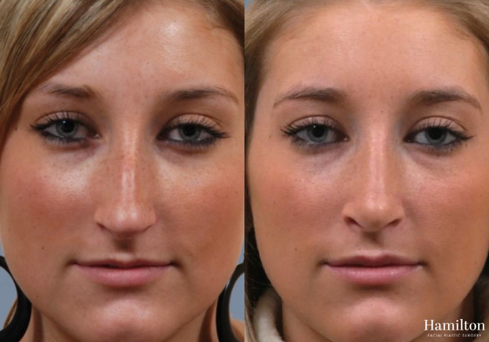 Before and after Rhinoplasty case 37211 - Angle 5