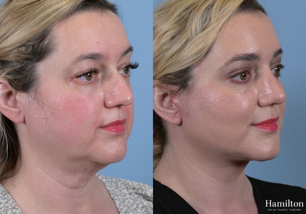 Before and after Rhinoplasty case 37276