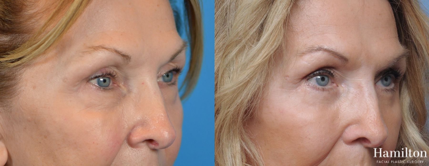 Before and after Blepharoplasty case 37129 - Angle 3