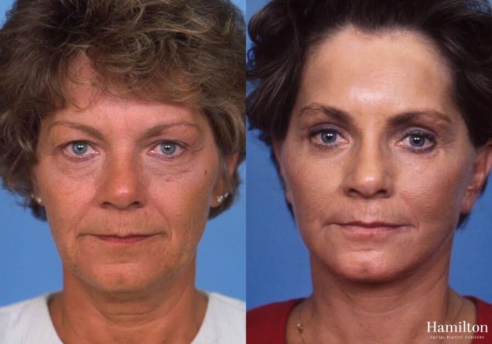 Before and after Facelift case 37324