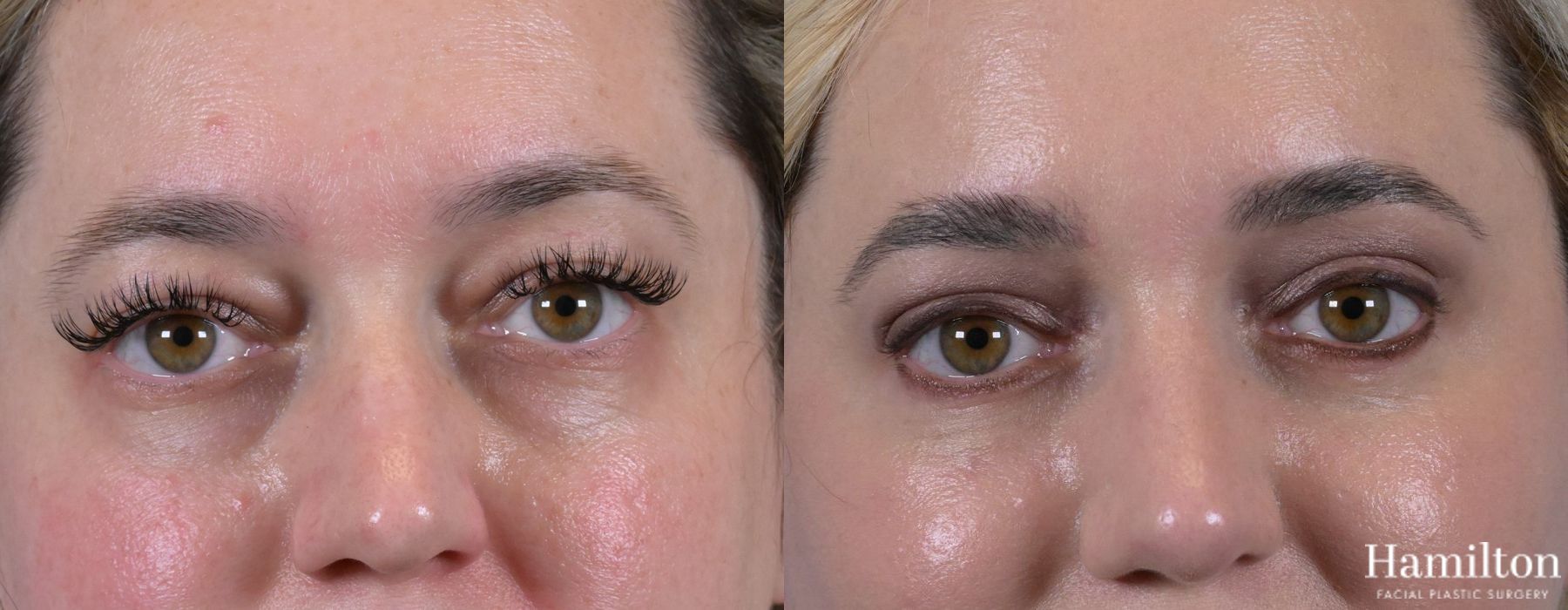 Before and after Blepharoplasty case 37133