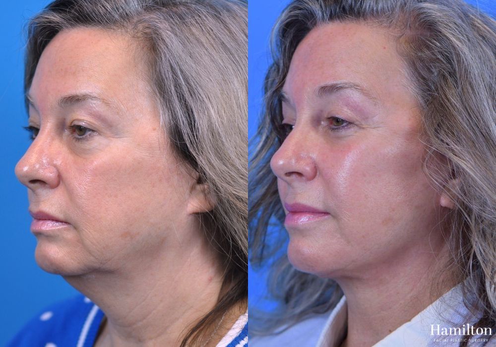 Before and after Facelift case 37294 - Angle 2