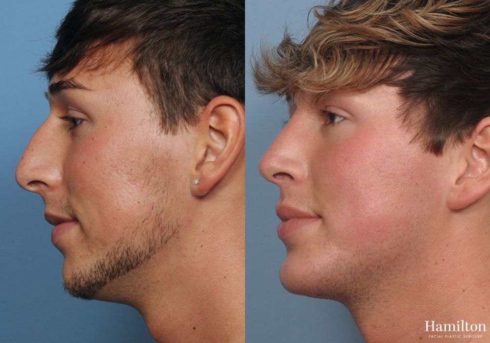 Before and after Rhinoplasty case 37293