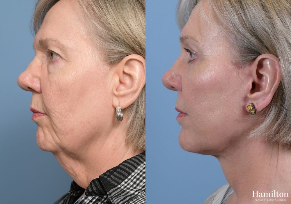 Before and after Brow Lift case 37139