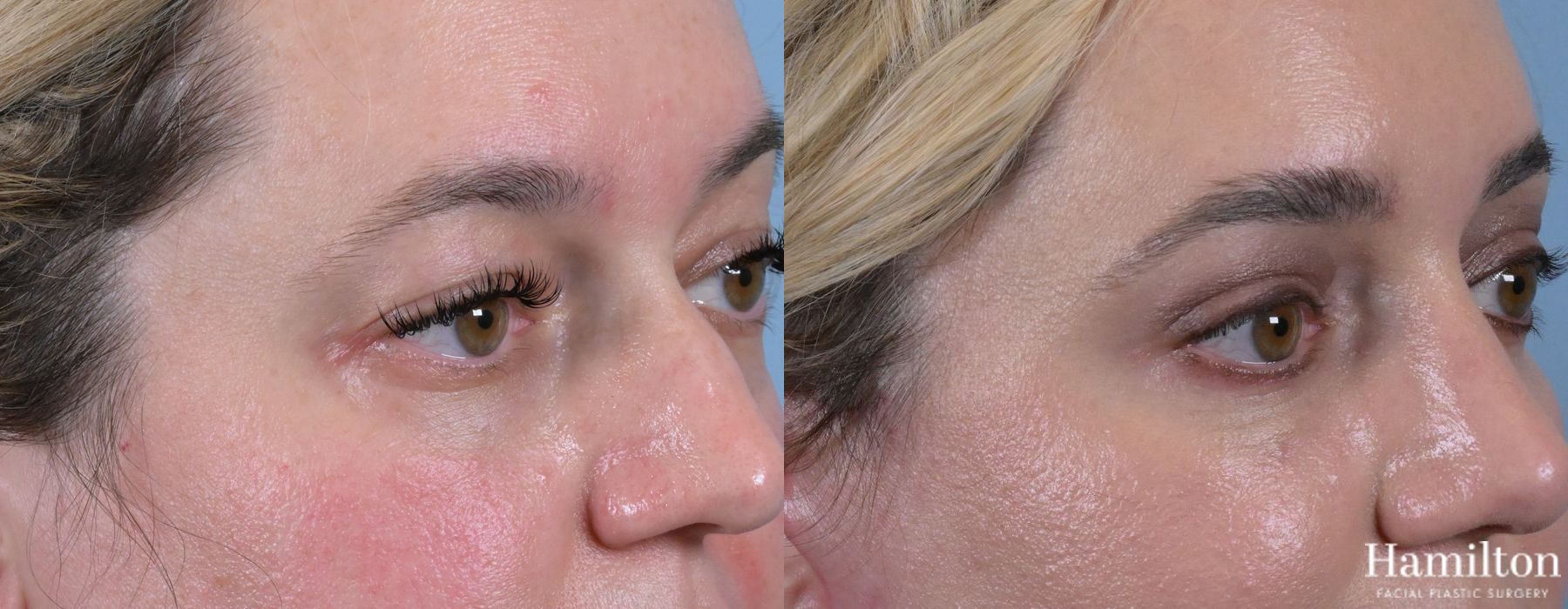 Before and after Blepharoplasty case 37133 - Angle 2
