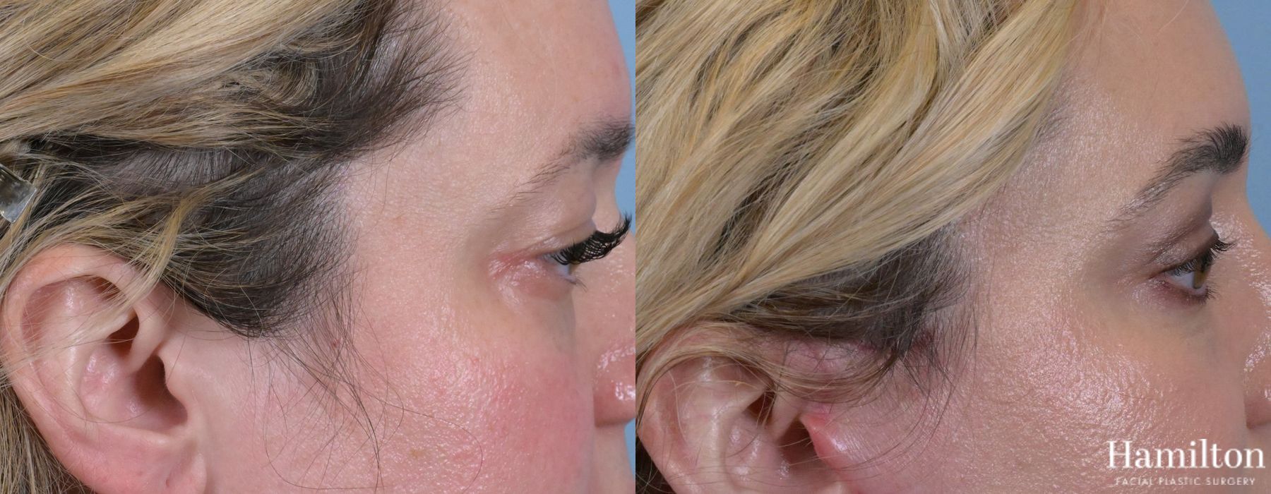 Before and after Blepharoplasty case 37133 - Angle 3