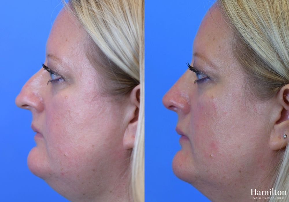 Before and after Rhinoplasty case 37311 - Angle 2