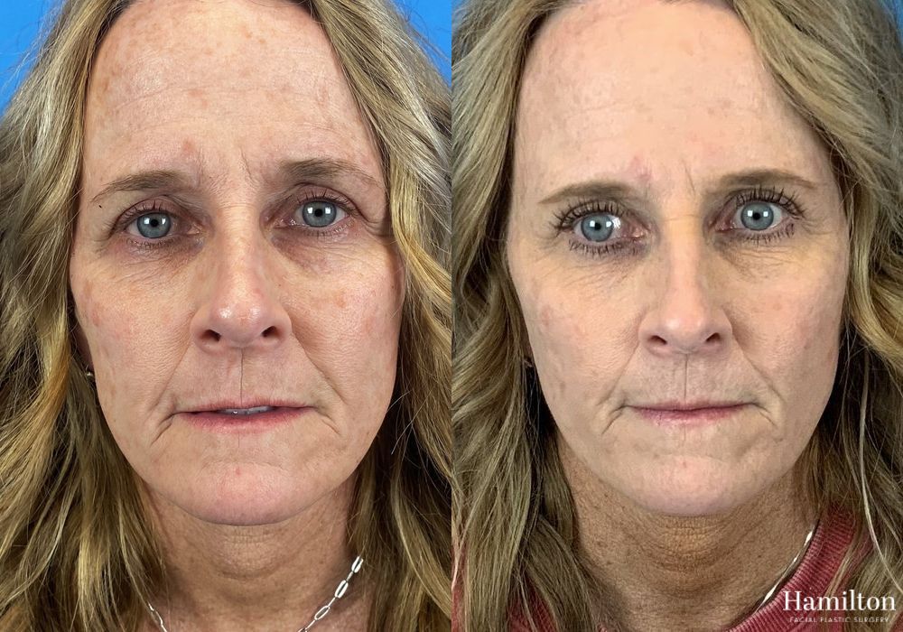 Before and after Laser - Broad Band Light (BBL) case 37213 - Angle 2